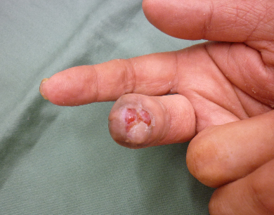 指尖部損傷”